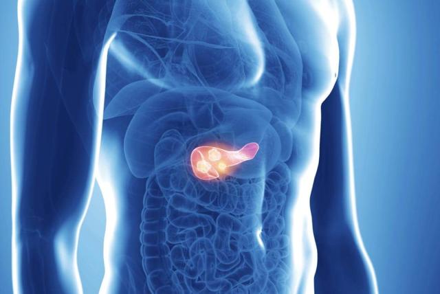 Dreamstime-Pancreatic-cancer_xxl_115598118_crop1280x750p_20241212144150.jpg